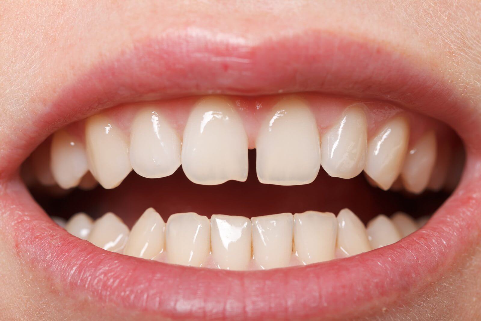 علل فاصله میان دندان‌ها چیست؟
