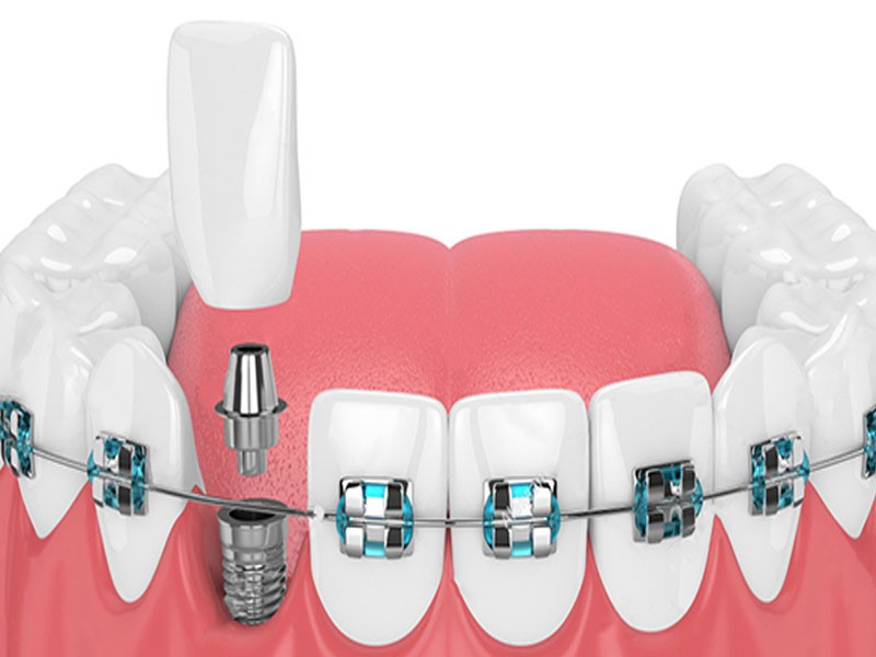 آیا ارتودنسی دندان های ایمپلنت شده امکان پذیر است؟ آیا ارتودنسی دندان های ایمپلنت شده امکان پذیر است؟