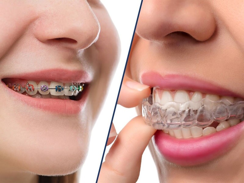 آیا ارتودنسی دندان های ایمپلنت شده امکان پذیر است؟ آیا ارتودنسی دندان های ایمپلنت شده امکان پذیر است؟